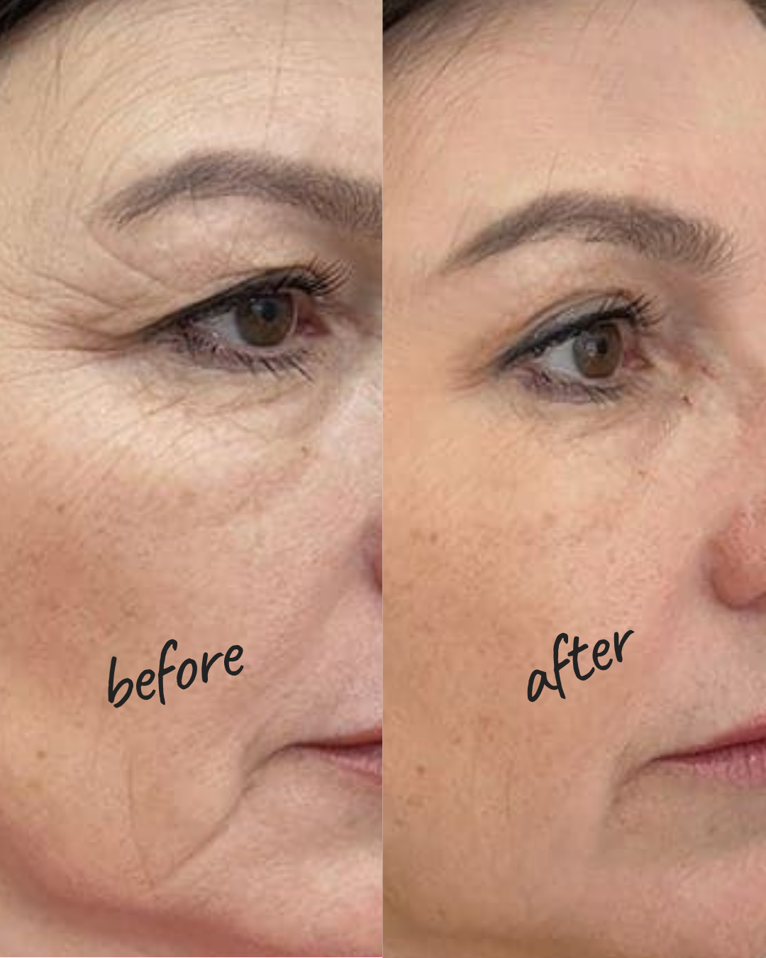 Skin Tightening Treatment NYC — Before and After