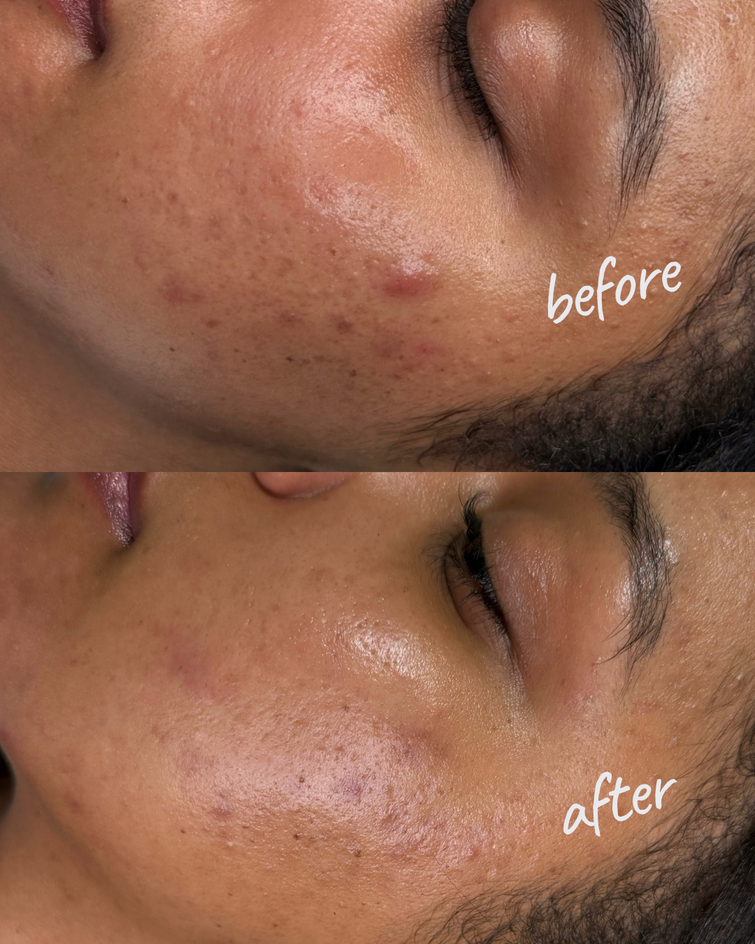 Chemical Peel Treatment NYC — Before and After