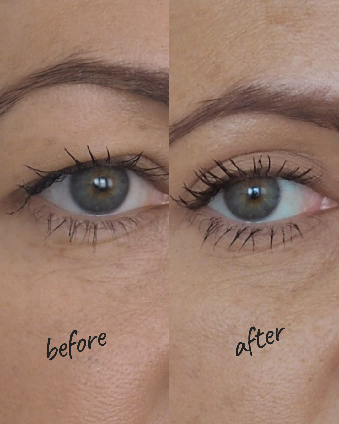 Non-Surgical Eyelid Lift NYC — Before and After