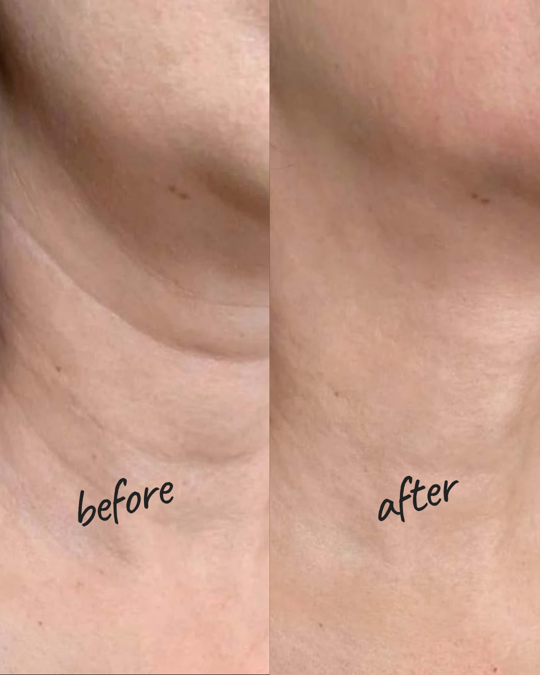 Stretch Marks, Scars, and Pores Treatment NYC — Before and After