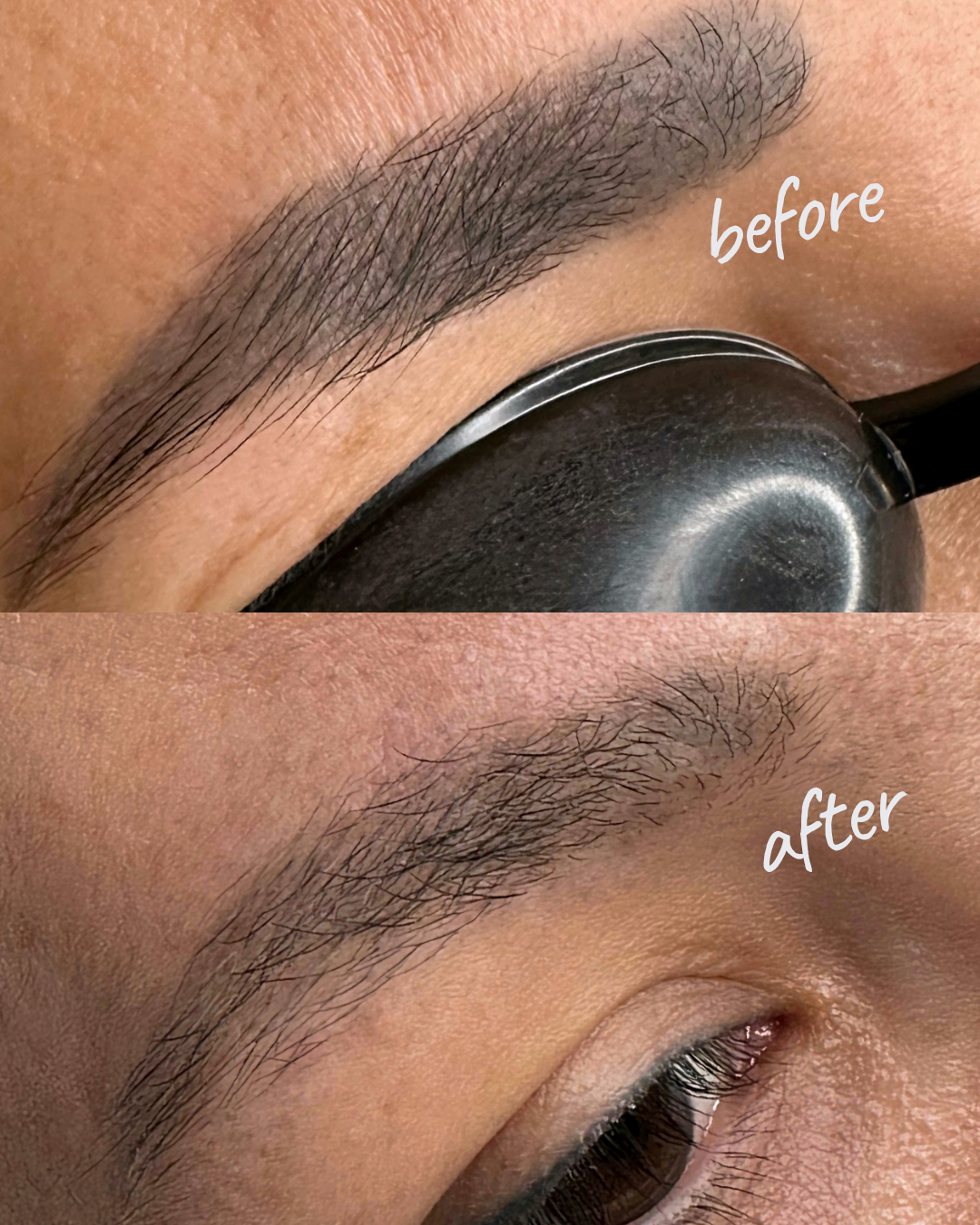 Tattoo and Permanent Makeup Removal NYC — Before and After